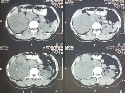 Radical nephrectomy for a giant chromophobe renal cell carcinoma diagnosed > 17 years previously: a case report and literature review
